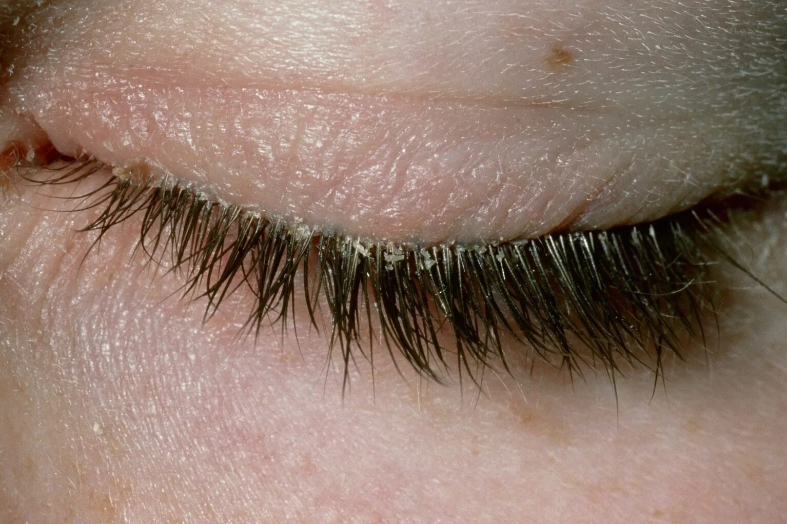 Признаки ресничного клеща фото Blepharitis - NHS