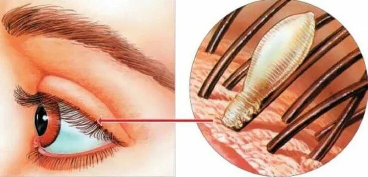 Признаки ресничного клеща фото В последние несколько лет наращивание ресниц стало очень популярным, особенно ср
