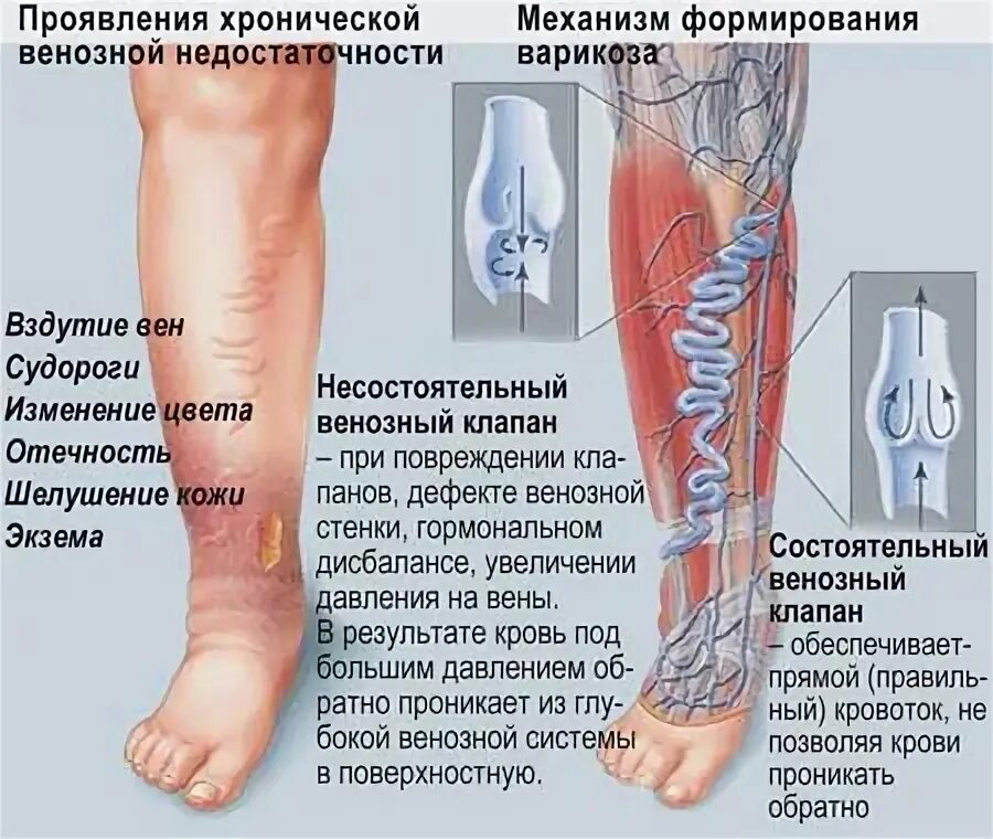 Признаки рожи на ноге симптомы фото Отек нижней трети голени - найдено 90 картинок