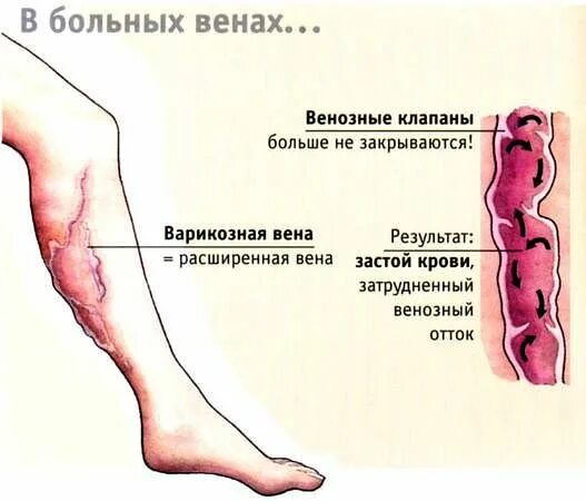 Признаки рожи на ноге симптомы фото Проявления варикозной болезни - Медицинский центр в Москве