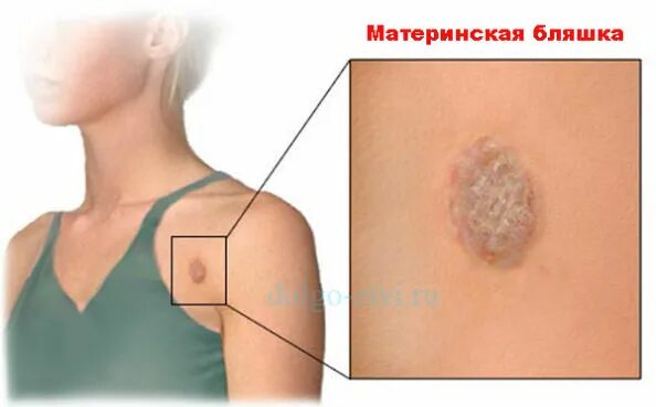 Признаки розового лишая и фото Герпес на теле: симптомы, причины и лечение кожных высыпаний best-facebook.ru