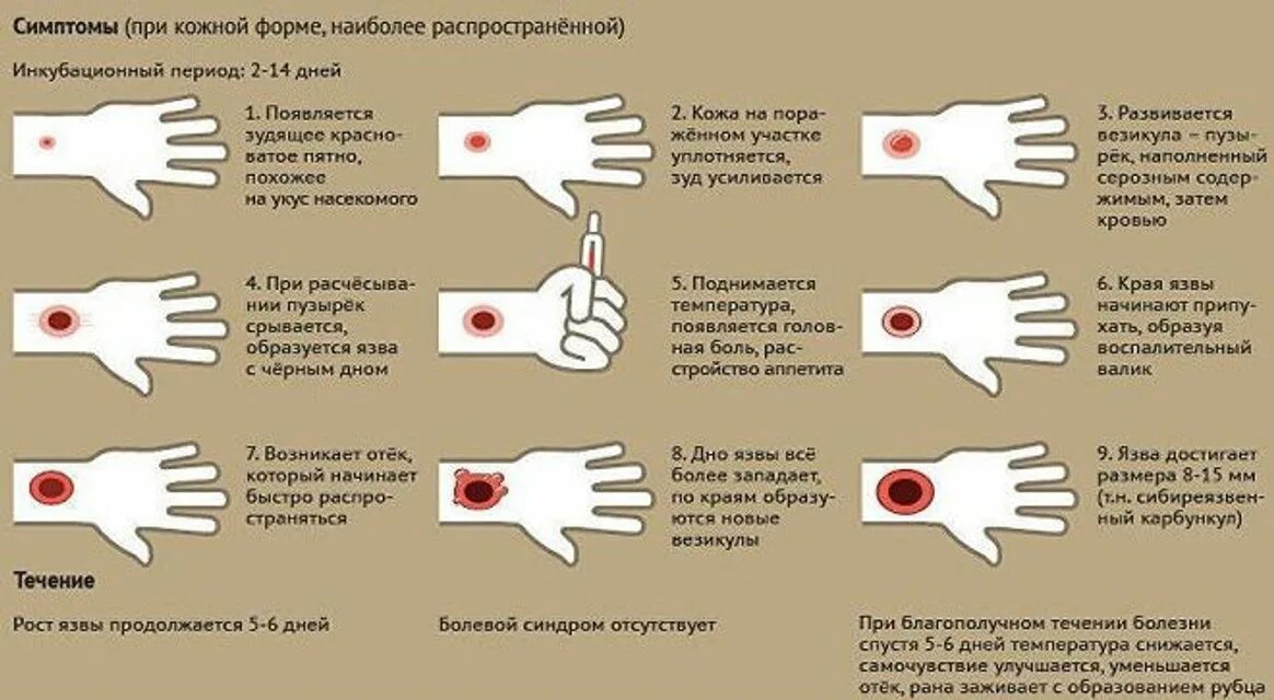 Признаки сибирской язвы у человека фото Сибирская язва - Глубокский районный центр гигиены и эпидемиологии
