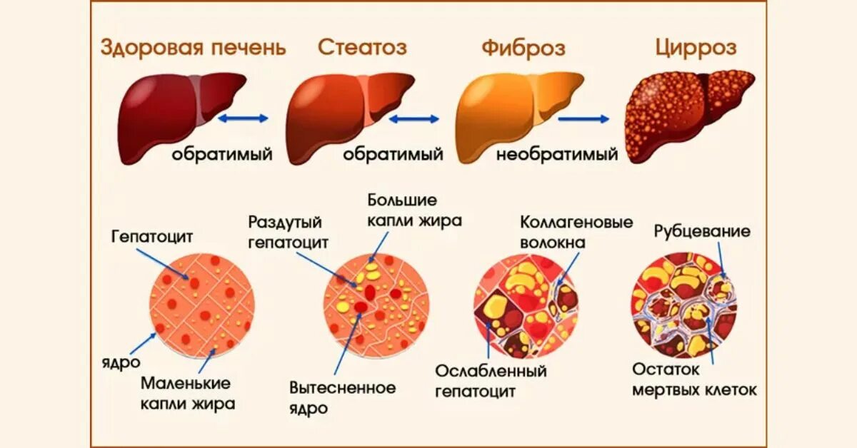 Признаки цирроза печени у женщин фото Стадии фиброза