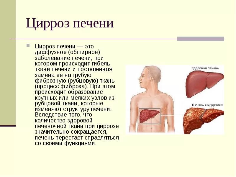 Признаки цирроза печени у женщин фото Цирроз печени