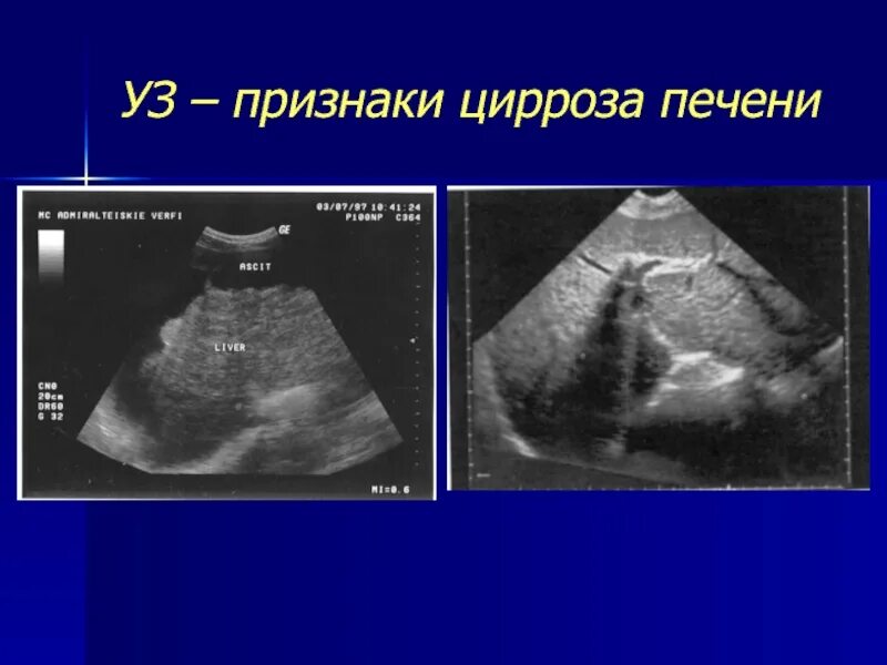 Наиболее характерная локализация боли при заболеваниях селезенки