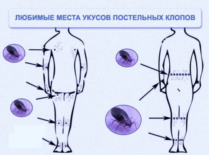 Признаки укусов клопов у человека фото Клопы, тараканы, препаратами без запаха, бесплатная консультация - Дезинфекция п