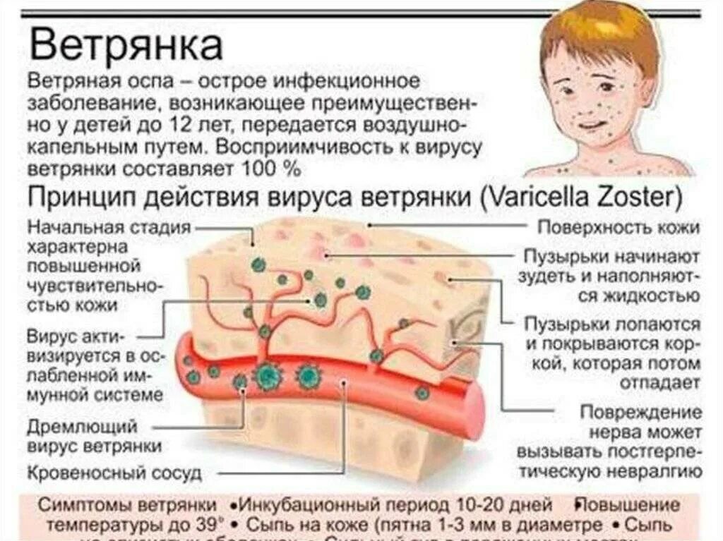 Признаки ветрянки у взрослых симптомы фото Этиология сыпи