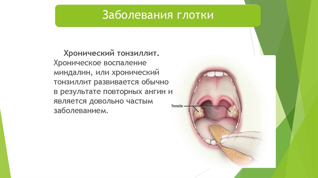 Гланды и миндалины: их роль, функции и особенности лечения ангины у детей