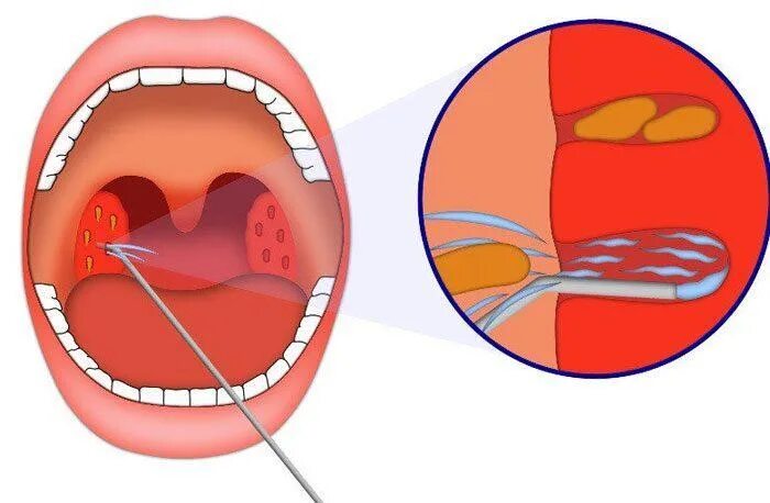 Пробка в горле у ребенка фото Вечно больное горло и ангины: что такое хронический тонзиллит и удалять ли минда