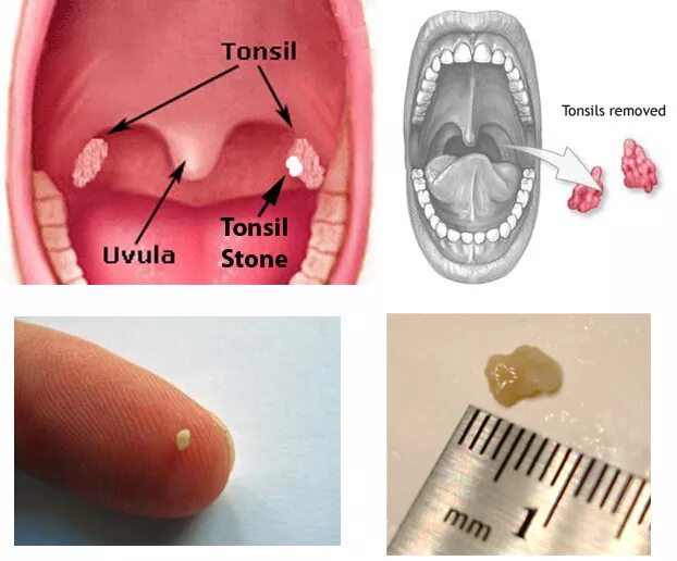 Пробка в горле у ребенка фото Antibiotic for swollen tonsils