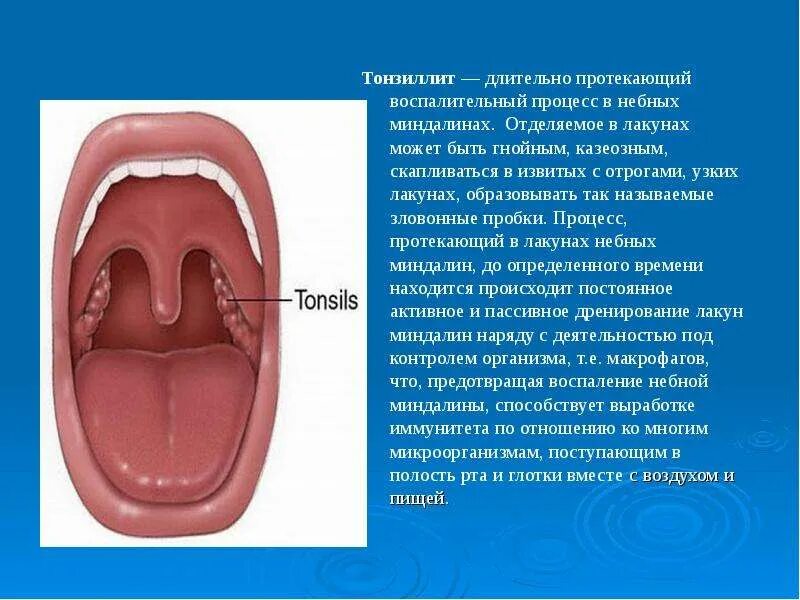 Пробка в горле у ребенка фото Симптомы и способы лечения тонзиллита у детей - особенности острого и хроническо