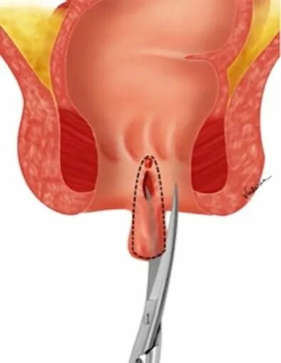 Пробка в попе фото Лечение анальной трещины