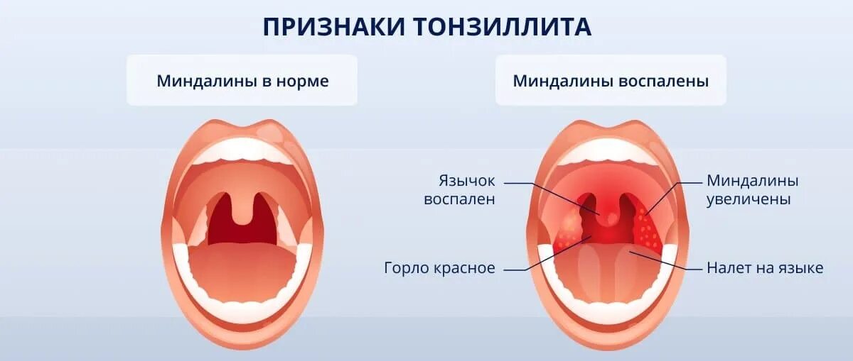 Пробки на миндалинах в горле фото Хронический тонзиллит: симптомы, причины и методы лечения болезни