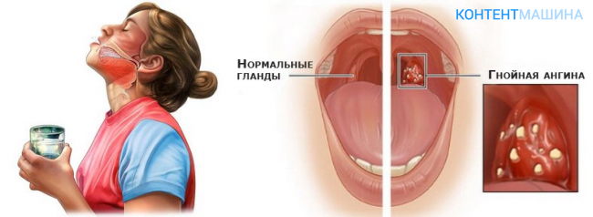 Пробки на миндалинах в горле фото Лечат ли ангину мороженым