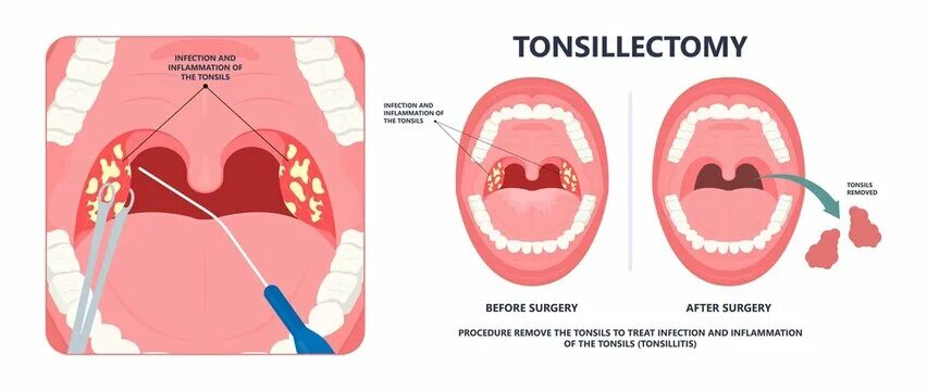 Пробки на миндалинах в горле фото Enlarged Tonsils Зображення - огляд 99 Стокові фото, векторні зображення й відео