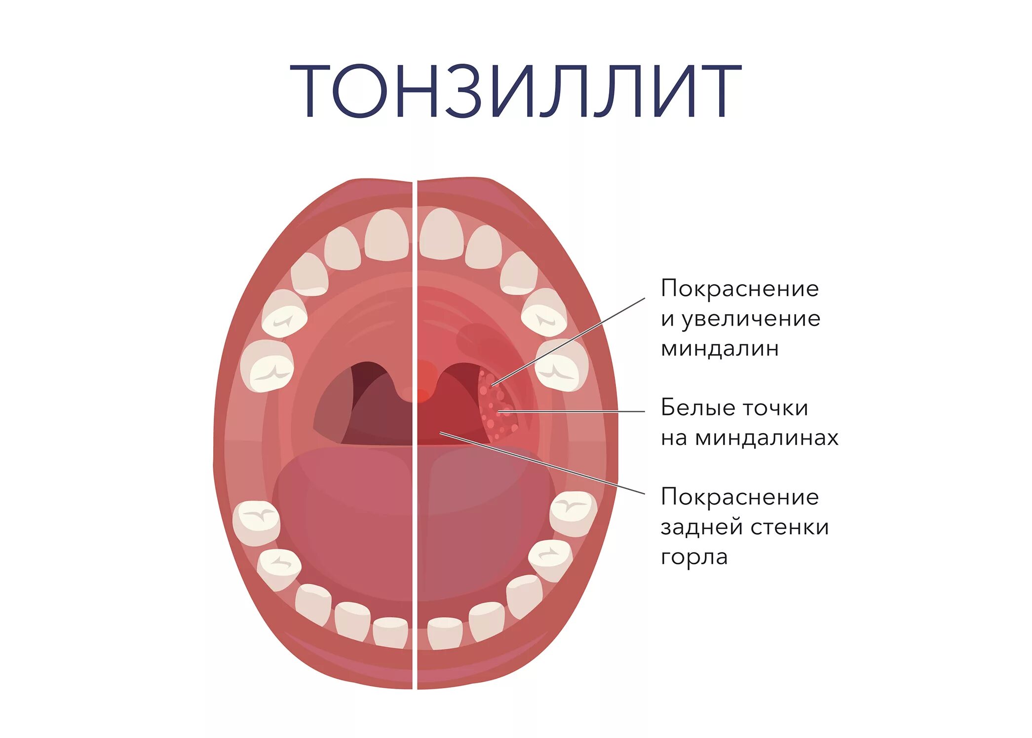 Пробки на миндалинах в горле фото ЛОДЭ медицинский центр - новости компании