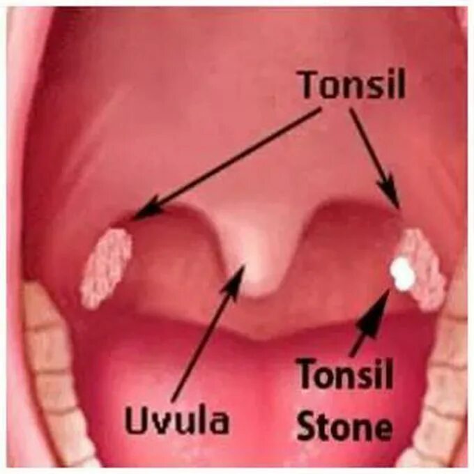 Пробки в горле фото Tonsil Stones - MEDizzy