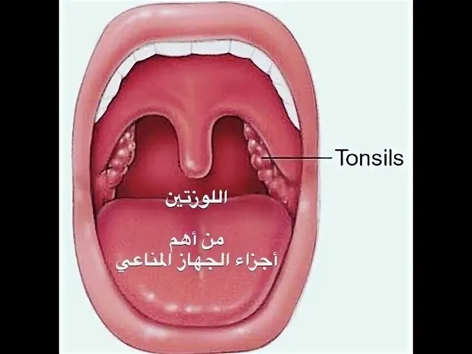 Пробки в горле фото как выглядит خطأ إستئصال اللوزتين Tonsils - YouTube