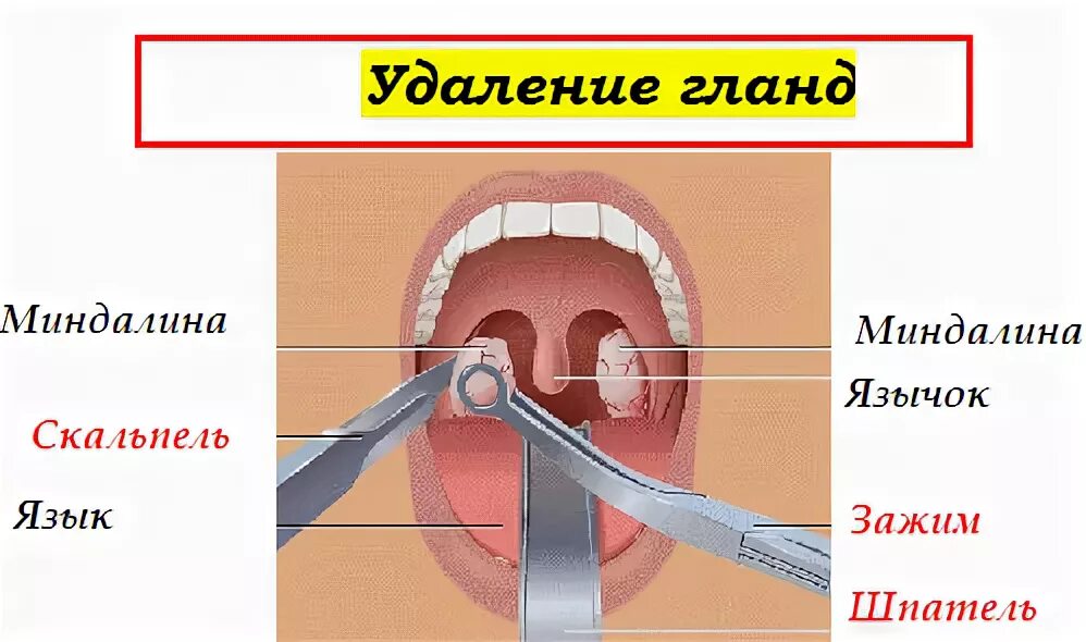 Пробки в горле фото как выглядит Причины и симптомы гнойных пробок в горле. Как избавиться от гнойных пробок в го