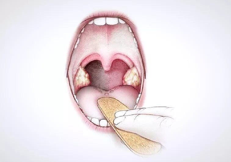 Пробки в горле фото как выглядит Налет на миндалинах