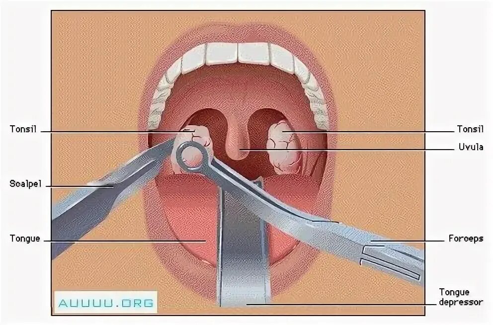 Пробки в горле причины лечение фото Pin on Beat Health Issues