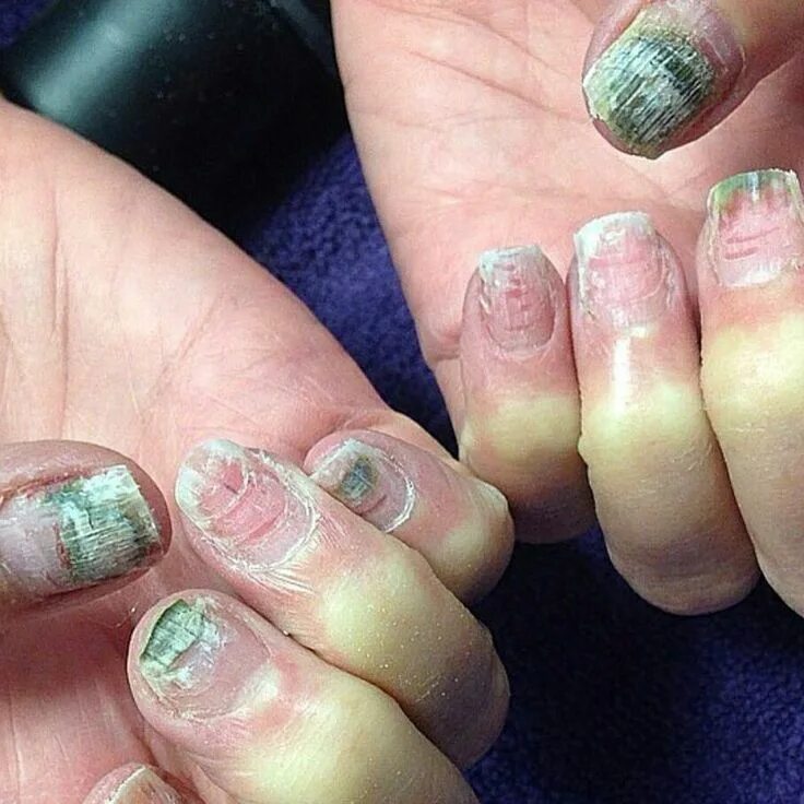 Проблемы ногтей фото This is what can happen if you go to cheap nail bars!! Cheap nail, Bad nails, Na