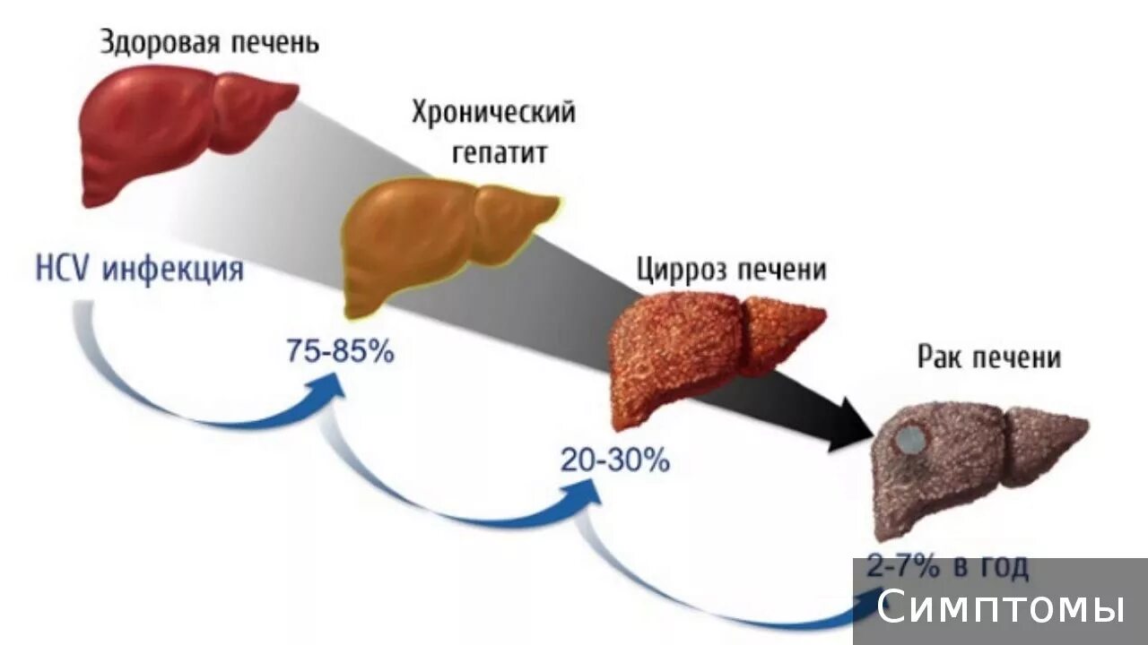 Печеночная недостаточность у взрослых: почему опасно, если орган начинает отказы