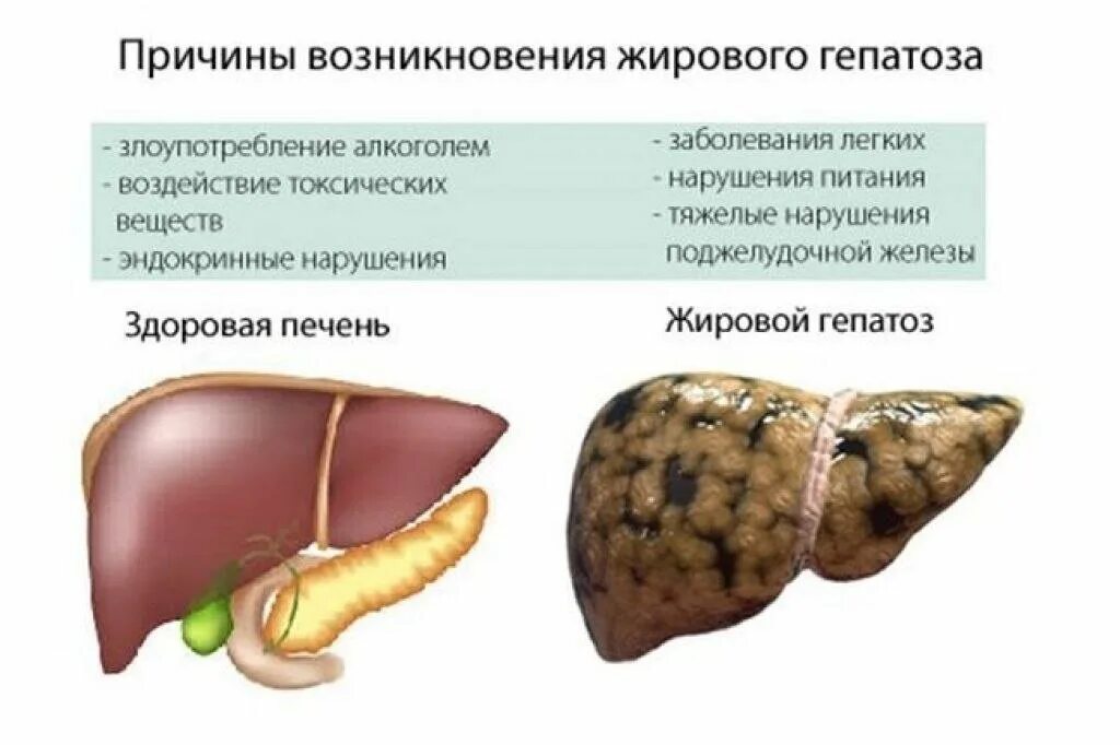 Проблемы с печенью фото Жировой гепатоз- что это и как избежать? Михайлова Наталья* Реабилитация сложных