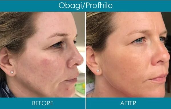 Профайло фото до и после Botox Wrinkle Removal Dublin Factory Sale beztabaka.by