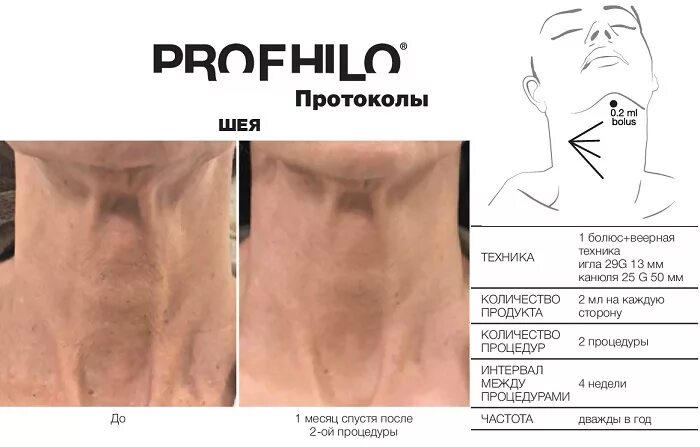 Профайло точки введения фото Биоревитализация кожи PROFHILO в Минске, цена