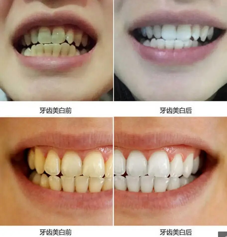 Профессиональная чистка зубов фото до и после Blanqueador de dientes,higiene Oral de limpieza,limpieza Dental, eBay