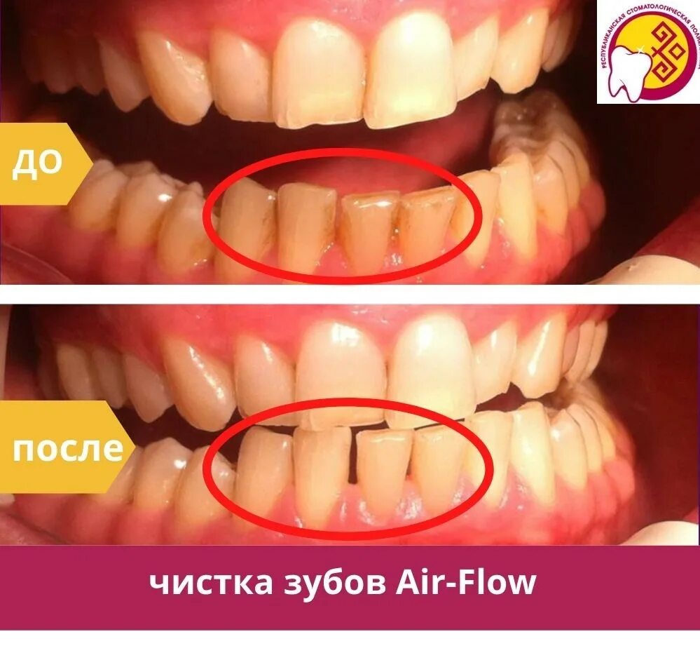 Профессиональная чистка зубов фото до и после Air-Flow: зубной налёт исчезает под воздушно-водной струёй - АУ "Республиканская