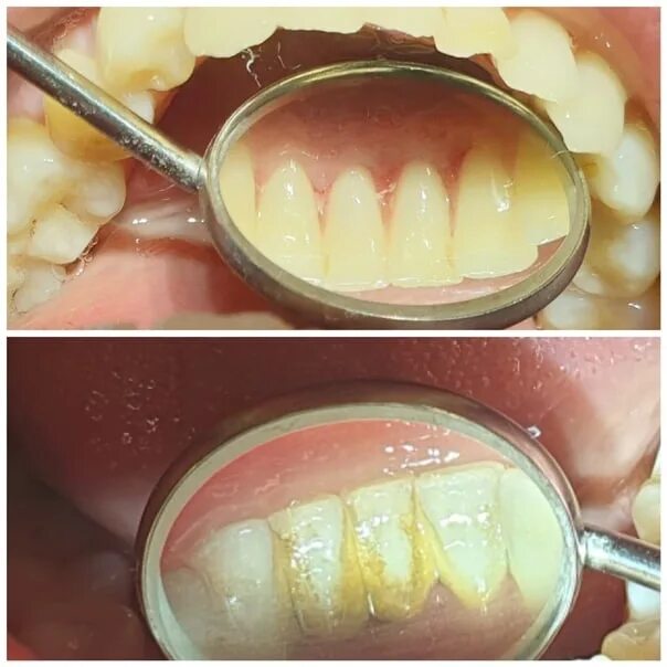 Профессиональная чистка зубов фото до и после Комплексная аппаратная чистка зубов 2022 Стоматологический кабинет "ВАУ-Дент" Ма