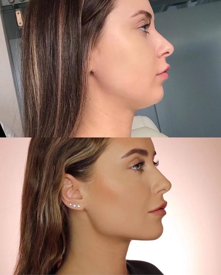 Профиль джоли фото до и после Skin by Lovely ™ on Instagram: "repost from @kristinaxmakeup : Side profile snat