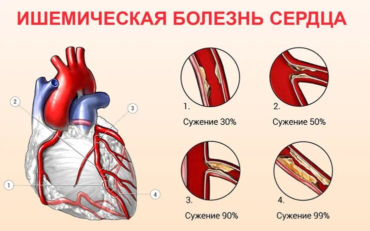 Профилактика ишемической болезни сердца фото Лечение ишемической болезни сердца (ИБС) в Москве: цены в клинике, врачи, отзывы