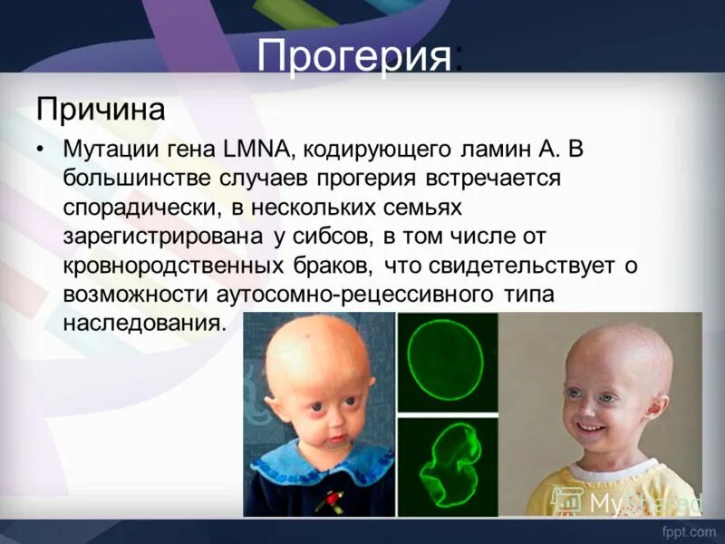 Прогерия болезнь у детей симптомы фото Family alienation syndrome