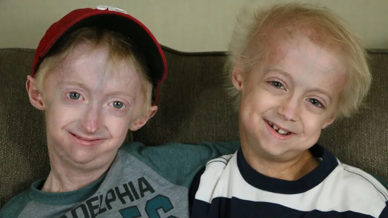 Прогерия болезнь у детей симптомы фото Brothers with Progeria (Nathan and Bennett) - YouTube