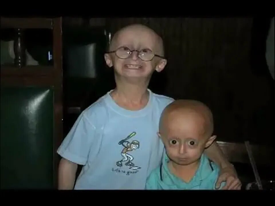 Прогерия болезнь у детей симптомы фото PRF The first-ever progeria clinical drug trial - YouTube