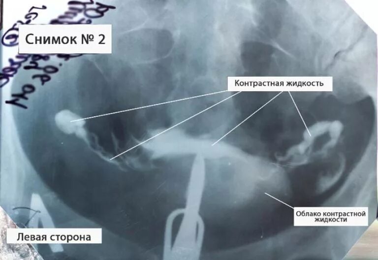 Проходимые маточные трубы фото Рентген маточных труб: как делают, больно ли, стоимость процедуры