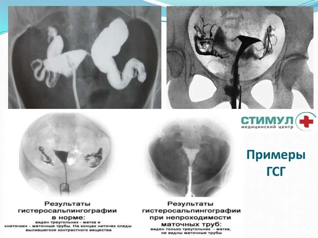 Проходимые маточные трубы фото Медицинский центр "Стимул" г. Сибай: записи сообщества ВКонтакте