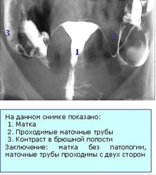 Проходимые маточные трубы фото Больные маточные трубы: найдено 88 изображений