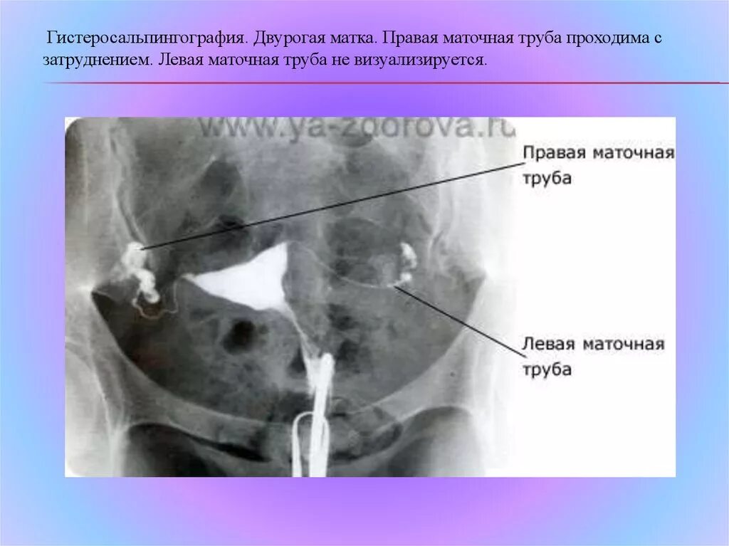 Проходимые маточные трубы фото Гсг наркоз: найдено 76 изображений