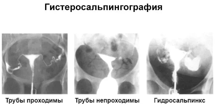 Проходимые трубы фото Как делают проходимость труб у женщин