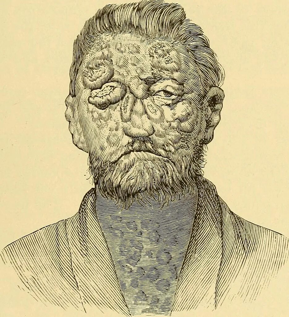 Проказа последняя стадия фото Image from page 726 of "A practical treatise on diseases o. Flickr