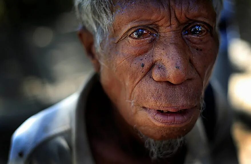 Проказа последняя стадия фото leprosy_7383 - Washington Times