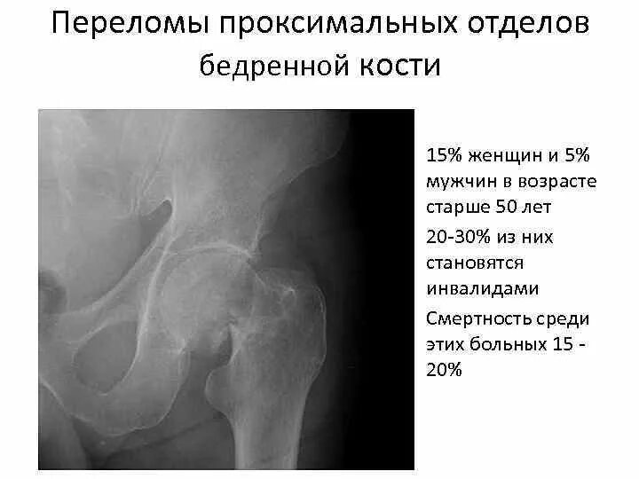 Проксимальный отдел бедренной кости фото Клинические рекомендации проксимальный отдел бедренной кости: найдено 88 картино