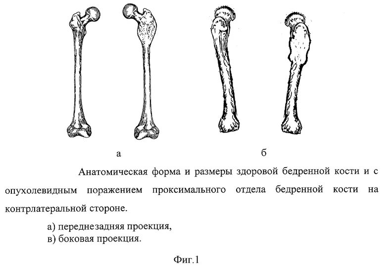 Проксимальный отдел бедренной кости фото СПОСОБ ИНДИВИДУАЛЬНОГО ВОССОЗДАНИЯ ПРОКСИМАЛЬНОГО ОТДЕЛА БЕДРЕННОЙ КОСТИ. Россий