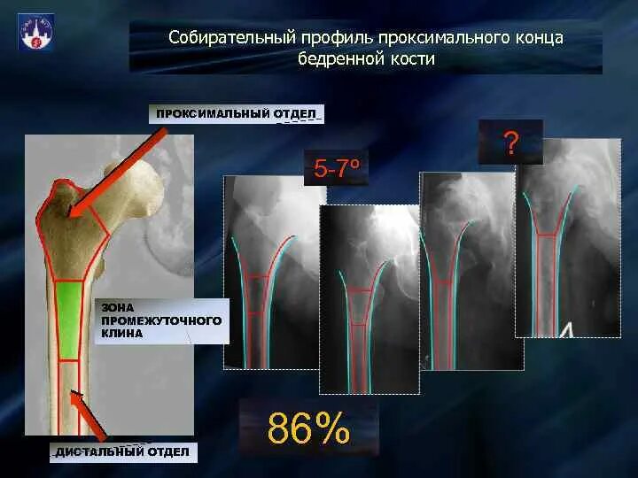 Проксимальный отдел бедренной кости где находится фото Картинки ПРОКСИМАЛЬНОЕ БЕДРО