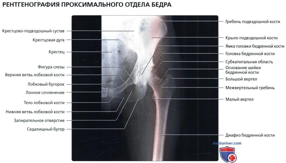 Проксимальный отдел бедренной кости где находится фото Рентгенограмма бедра в норме