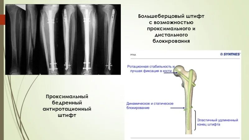 Проксимальный отдел большеберцовой кости фото Проксимальный дистальный медиальный - найдено 83 картинок